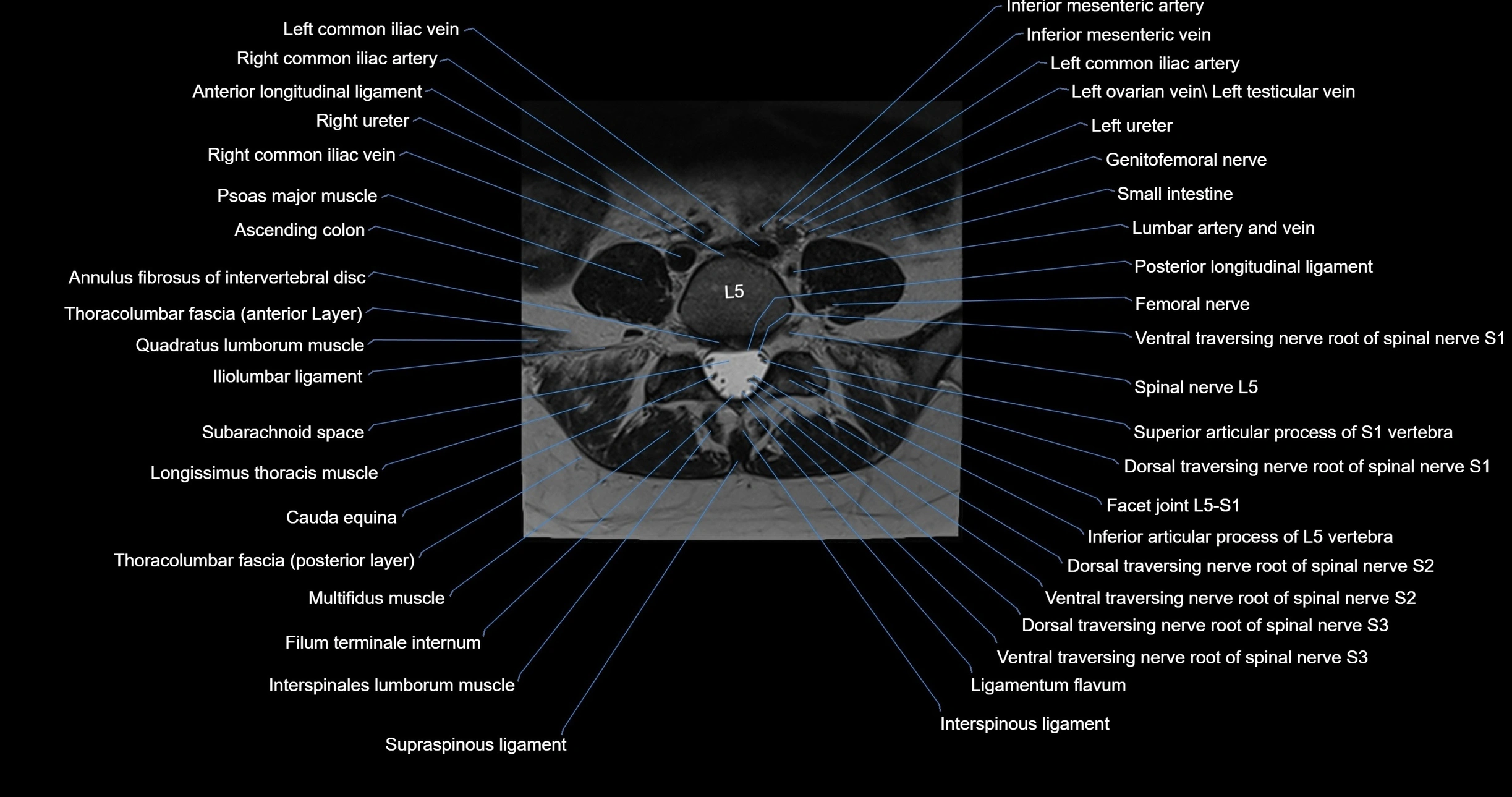 MRI lumbar spine axial cross sectional anatomy 3T radiology  image-img-00001-00040.webp